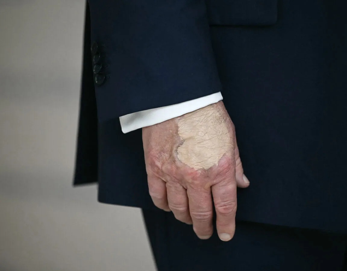 Foltok jelentek meg Donald Trump bal halántékán, elkezdődtek a találgatások