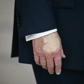 Foltok jelentek meg Donald Trump bal halántékán, elkezdődtek a találgatások