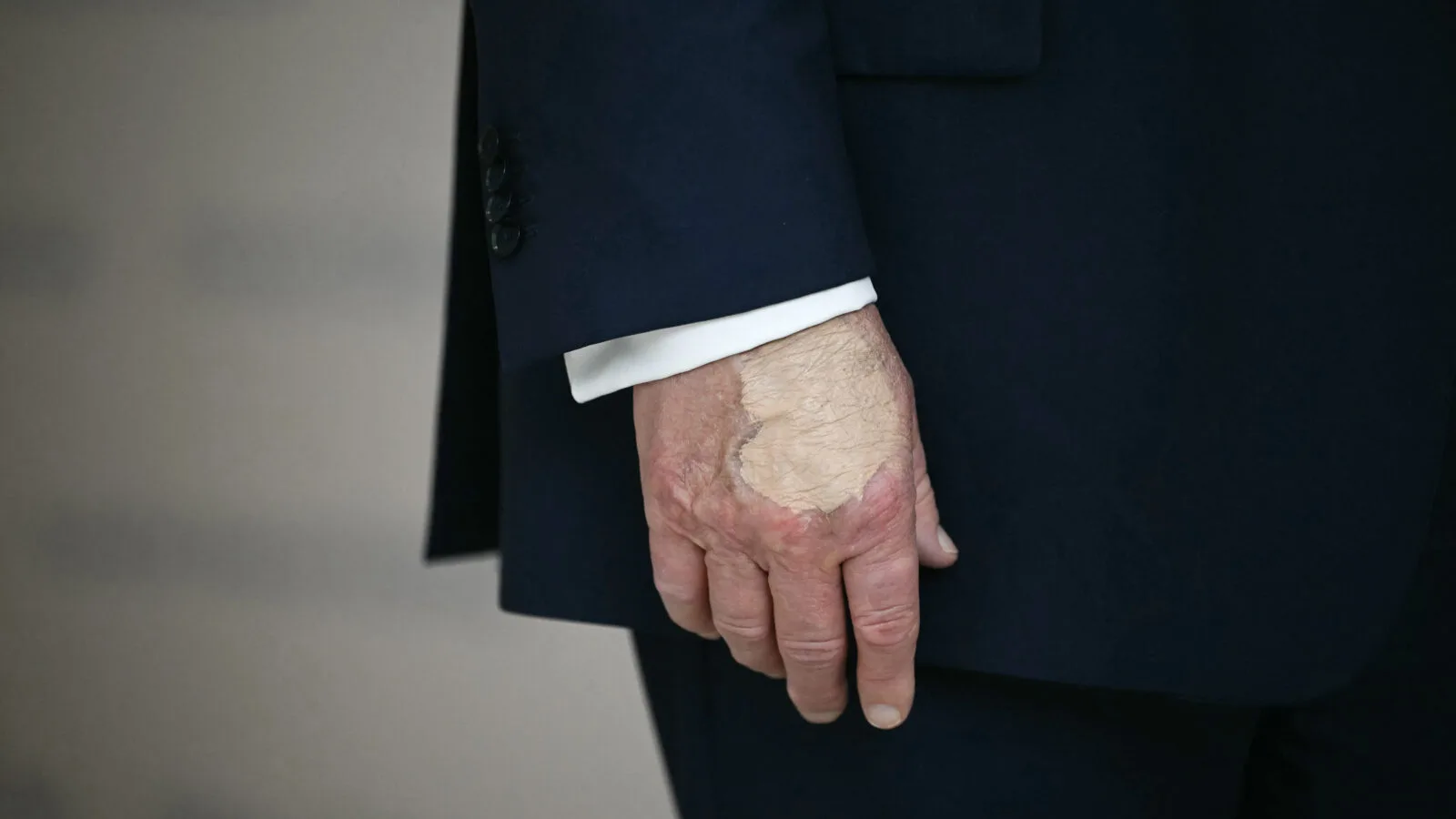 Foltok jelentek meg Donald Trump bal halántékán, elkezdődtek a találgatások